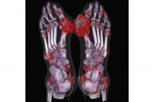 снимок стопы с подагрой